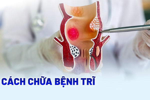 Cách chữa bệnh trĩ nội, ngoại, hỗn hợp – Phương pháp mới, hiệu quả nhanh