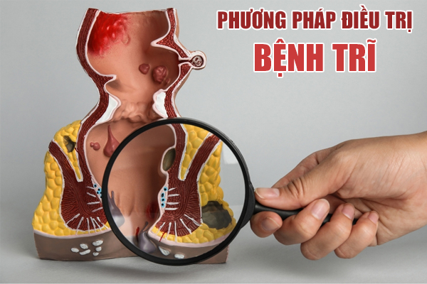 Các phương pháp hỗ trợ chữa bệnh trĩ phổ biến hiện nay