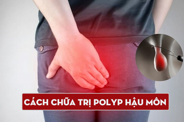 Chữa trị Polyp hậu môn – Phương pháp hiện đại, nhanh khỏi, ít đau