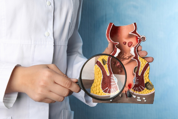 Cách điều trị bệnh trĩ ngoại và nội hiệu quả – Tư vấn từ chuyên gia