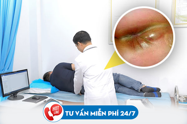Áp xe hậu môn có tự khỏi không? Địa chỉ khám Apxe hậu môn uy tín