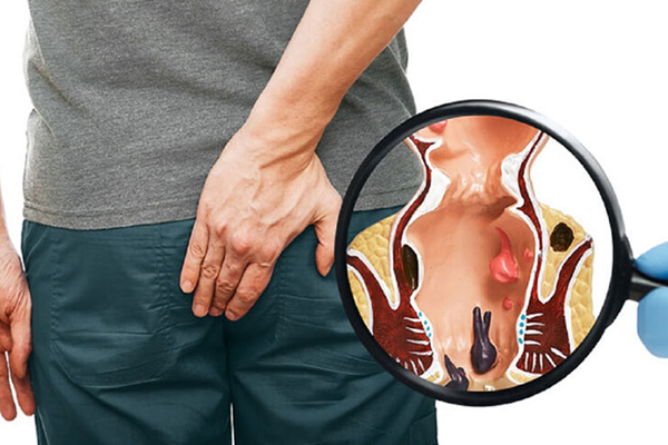 7 bệnh hậu môn thường gặp mà bạn nên biết