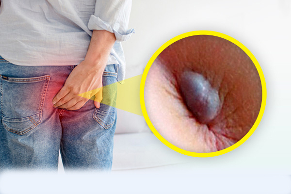 Hậu môn lòi thịt là bị gì? Điều trị ra sao?