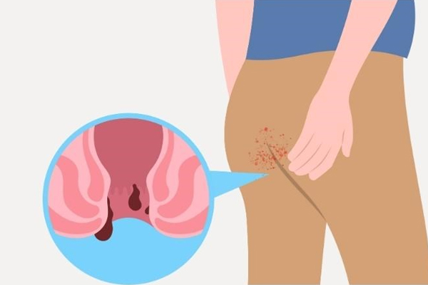 Nứt kẽ hậu môn có tự lành không? Nguyên nhân và biện pháp hỗ trợ điều trị